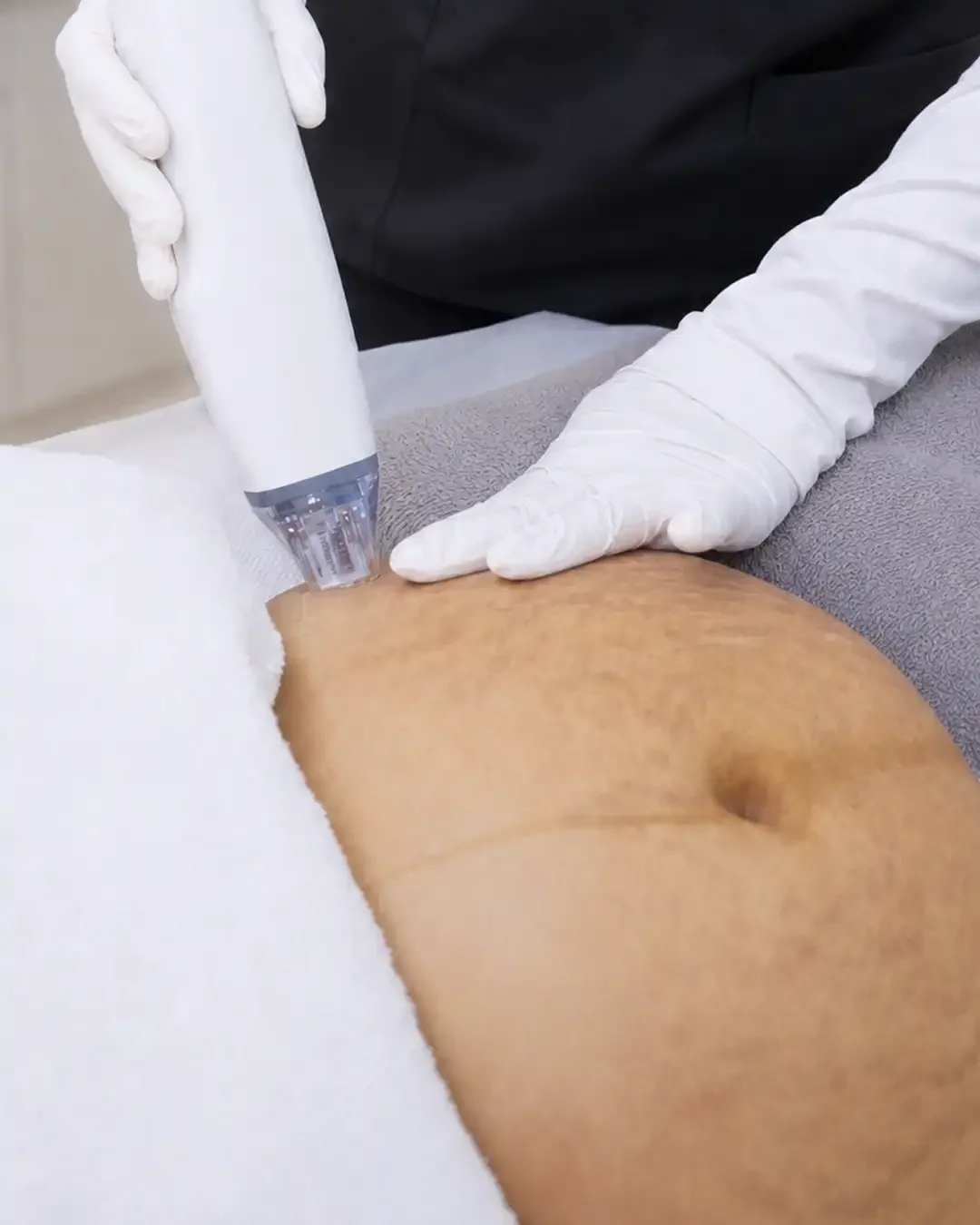 妊娠纹与生长纹（Stretch Marks）